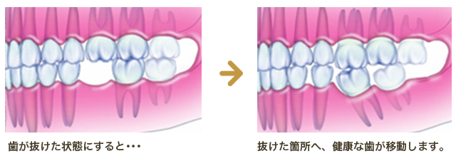 歯が抜けた状態だと、抜けた箇所へ健康な歯が移動します。